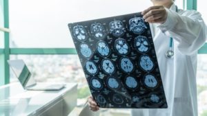 How Allen Law Firm, P.A. Can Help If You’ve Suffered a Brain Injury in Gainesville